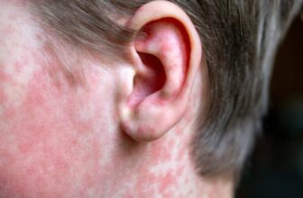 CDC Refuses to Take Blame for Measles Spiraling out of Management